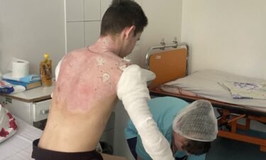 Oleksiy Paradovsky says about 20% of his body was burned in the missile attack.
