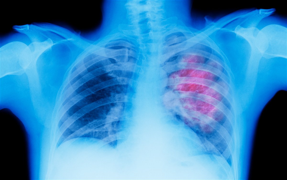 <i>Peter Dazeley/The Image Bank RF/Getty Images</i><br/>Seen here is an illustration of an X-ray depicting lung cancer. A new study shows that nearly half of deaths due to cancer can be attributable to preventable risk factors.