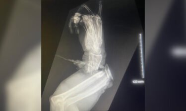 X-ray image shows the damage to Graziani's arm