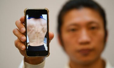 Hong Kong protester Bob Chan shows a photograph of his injuries at a news conference in London on October 19.