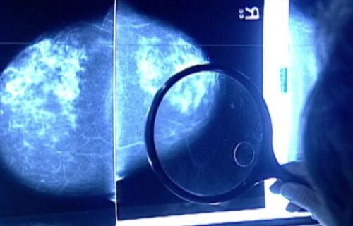 An experimental treatment shows promise for people with the most common form of advanced-stage breast cancer