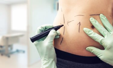 Liposuction overtakes breast augmentation as the most popular cosmetic surgery. A plastic surgeon here marks a woman's body for surgery.