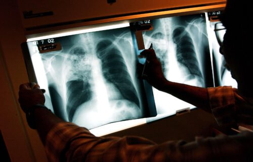 Many tuberculosis diagnoses may have been missed