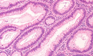 Microscopic image of a tubular adenoma. Adenomas are premalignant (precancerous) polyps of the colon and rectum. Colonoscopy can prevent cancer by removing adenomas before they transform to cancer.