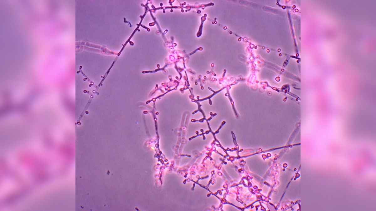 <i>CDC</i><br/>Two cases of Trichophyton indotineae have been identified in the US.