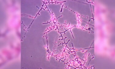 Two cases of Trichophyton indotineae have been identified in the US.