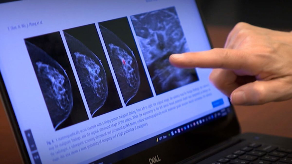 Artificial intelligence found more breast cancers than doctors with years of training and experience and cut doctors’ mammogram reading workload almost in half, a new early-stage study found.