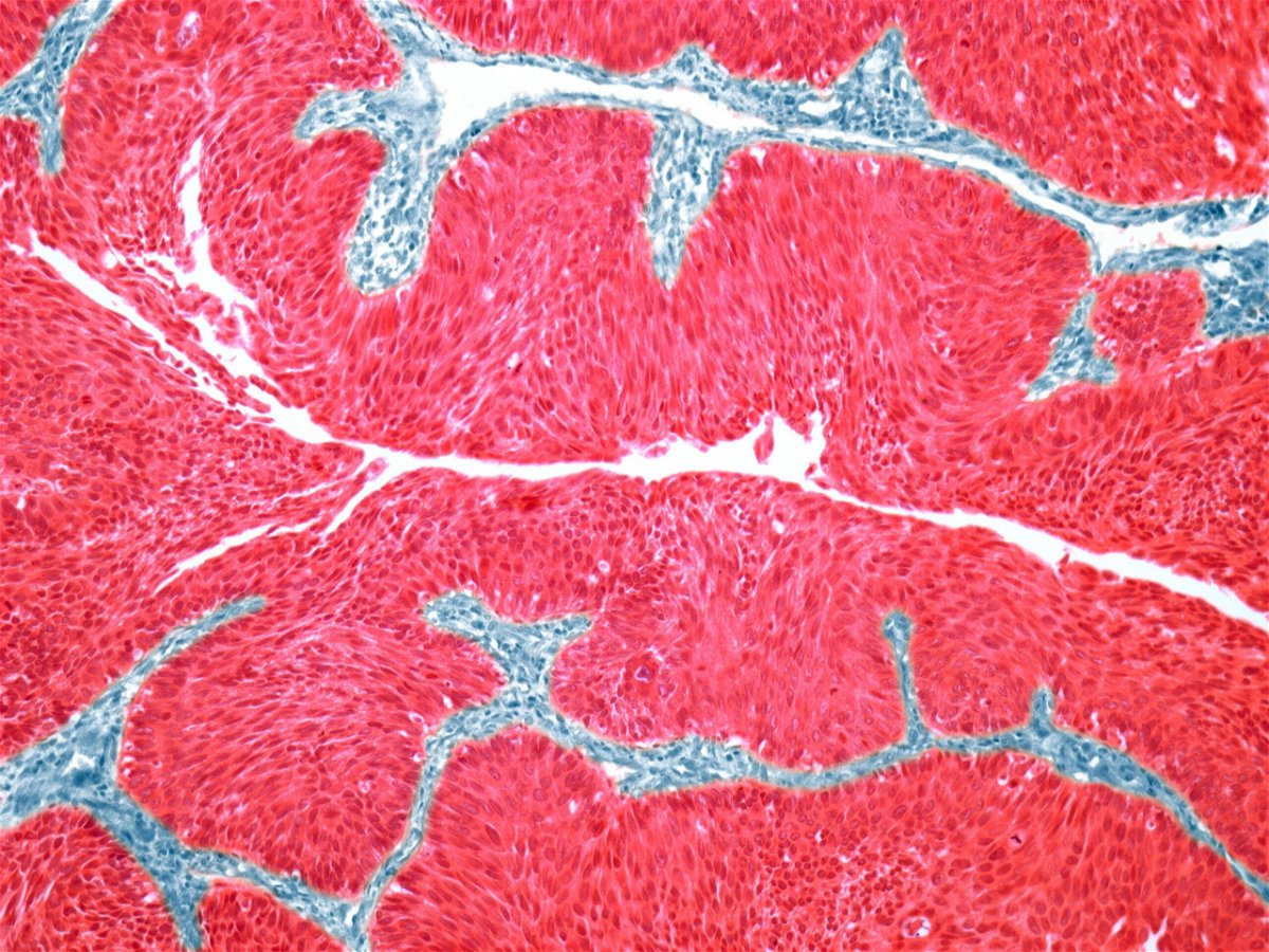 A light micrograph image of a section through a transitional cell carcinoma of the bladder wall. A new combination of cancer medications has been shown in research to extend overall survival in patients with advanced bladder cancer.