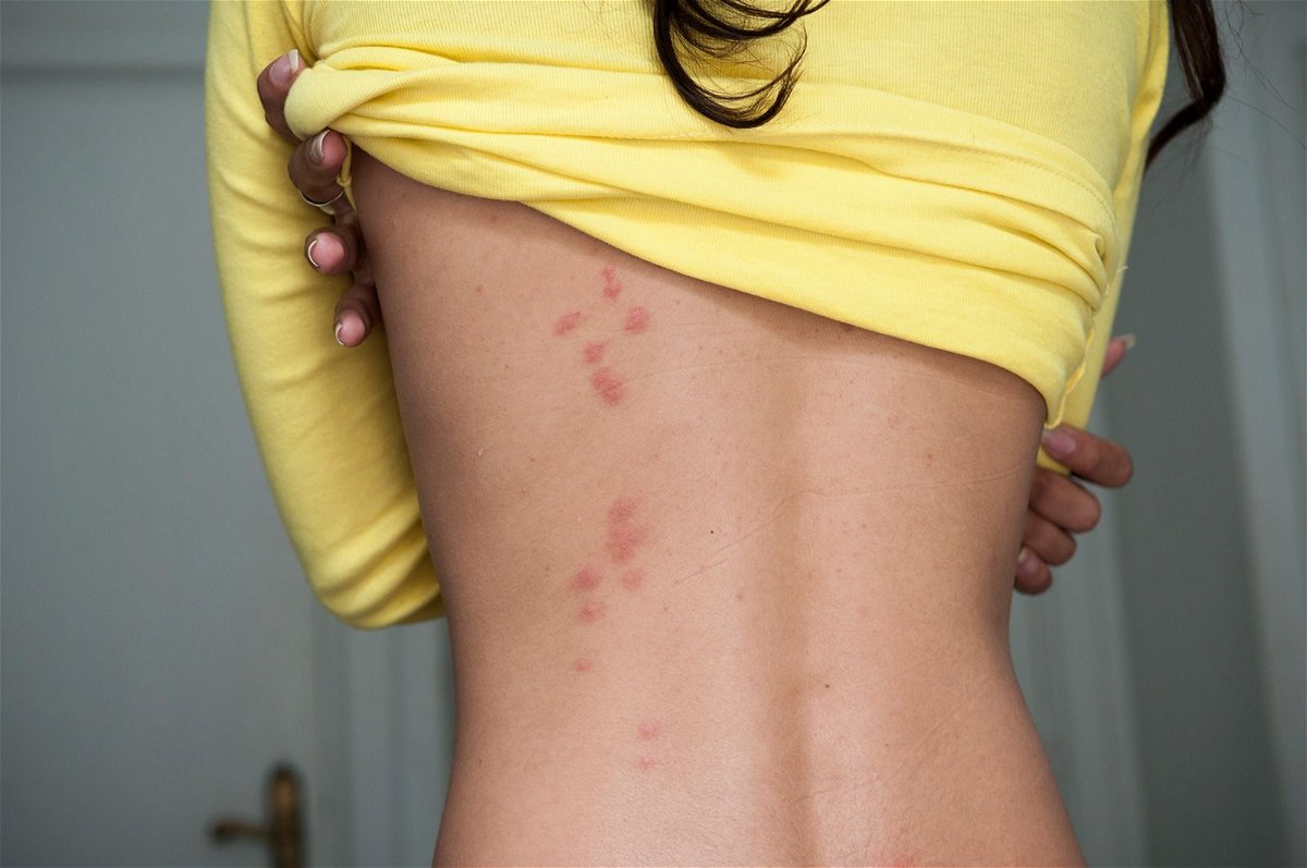 Bedbug bites are visible on the back of a woman standing in a hotel room.