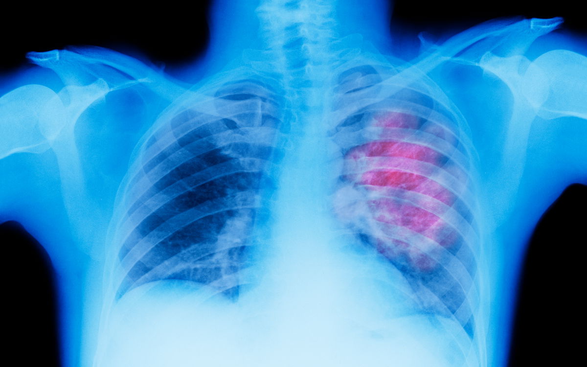 US lung cancer survival rates rise, but it’s still the leading cause of cancer death.