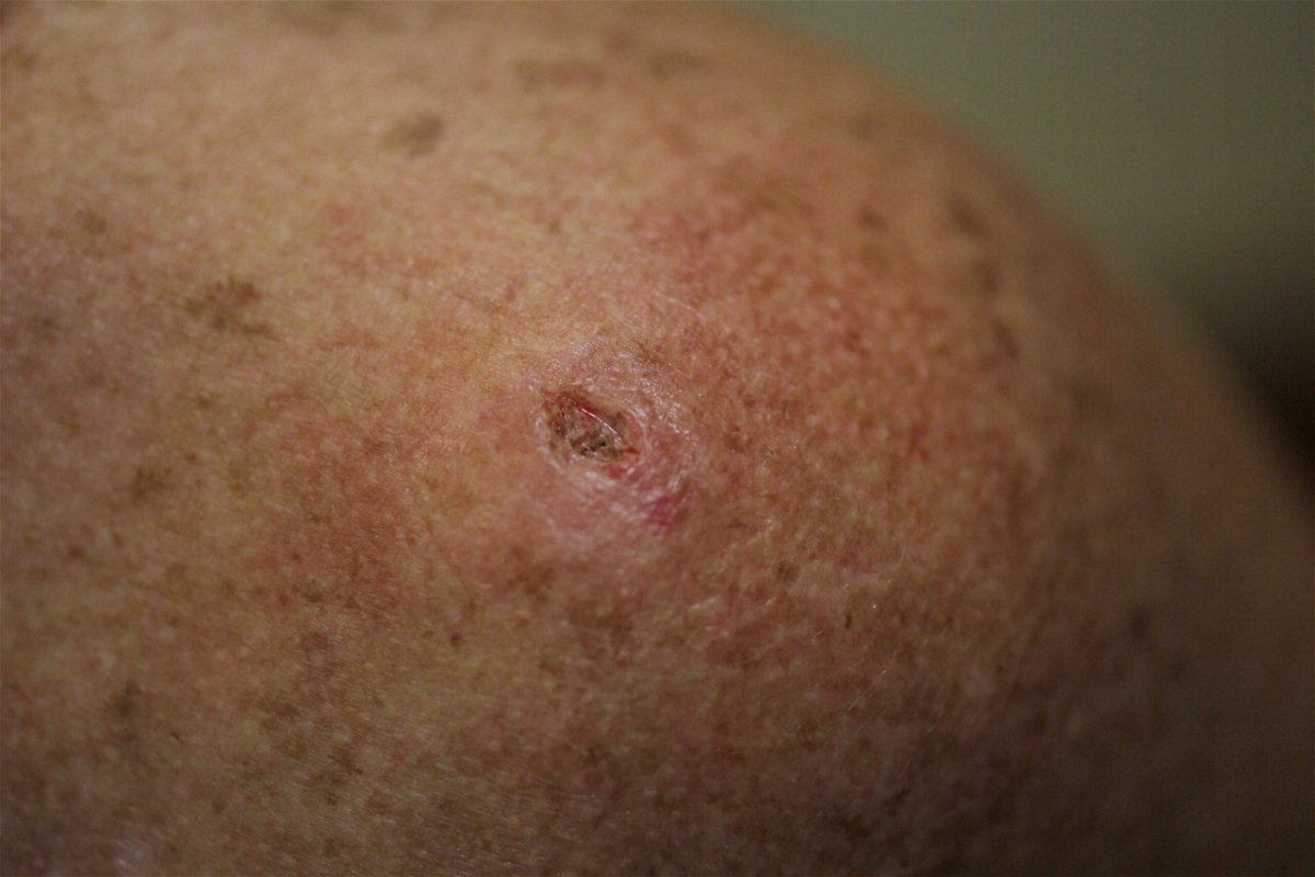 Amy Rey has a mark on her skin after a biopsy was performed on a lesion to check for cancer due to sun exposure on June 15, 2011 in Miami, Florida.