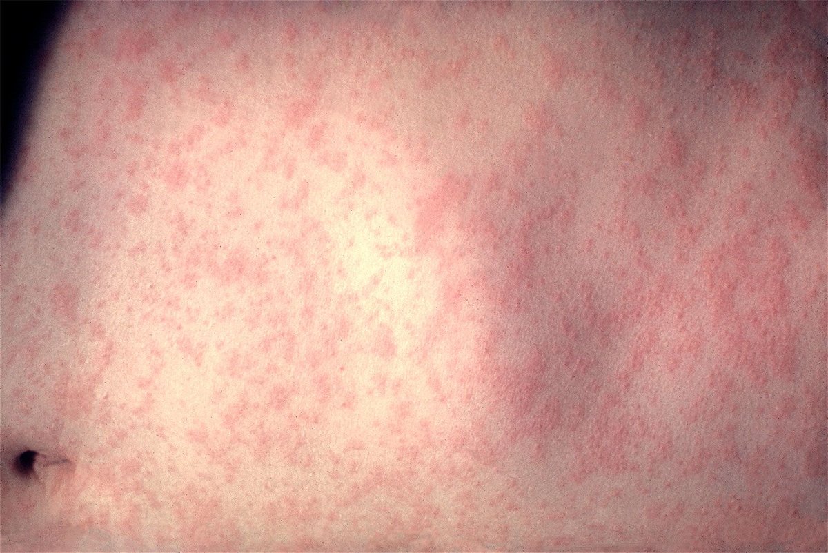 A red rash is one hallmark of a measles infection.