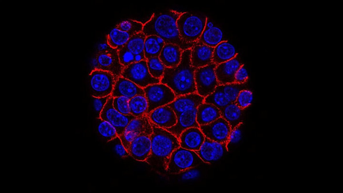 Pancreatic cancer cells, shown in blue, can be difficult to detect in early stages of the disease, and there is no single test that can tell you if you have pancreatic cancer early.