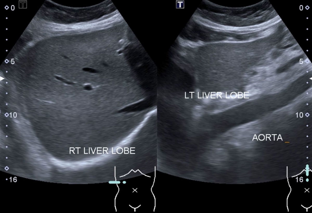 Liver transplant costs rose 11% after a new allocation policy was implemented, according to an analysis of 22 transplant centers.