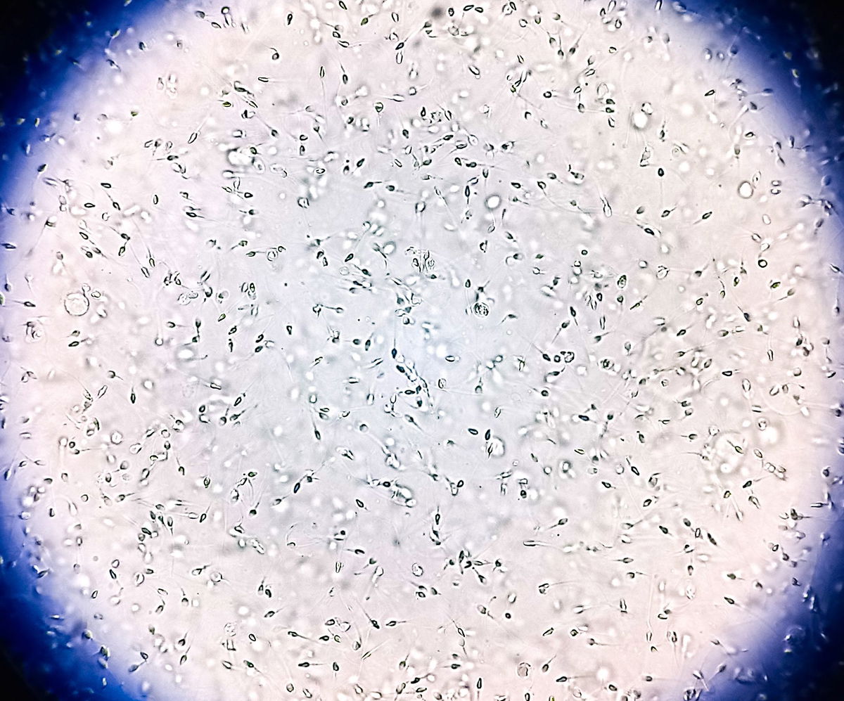 <i>Salah Uddin/iStockphoto/Getty Images via CNN Newsource</i><br/>Sperm from the donor was used to conceive at least 67 children from 46 families.